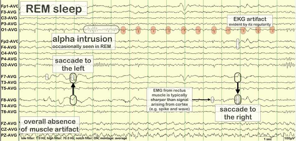 Understanding the concept of Amitriptyline Alpha Intrusion