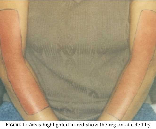 Amitriptyline for brachioradial pruritus