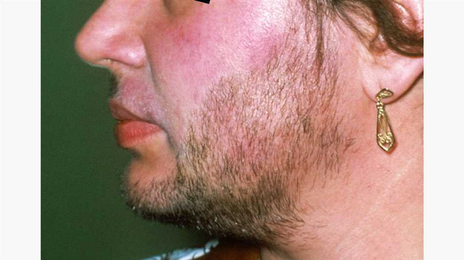 Can amitriptyline cause facial hair growth