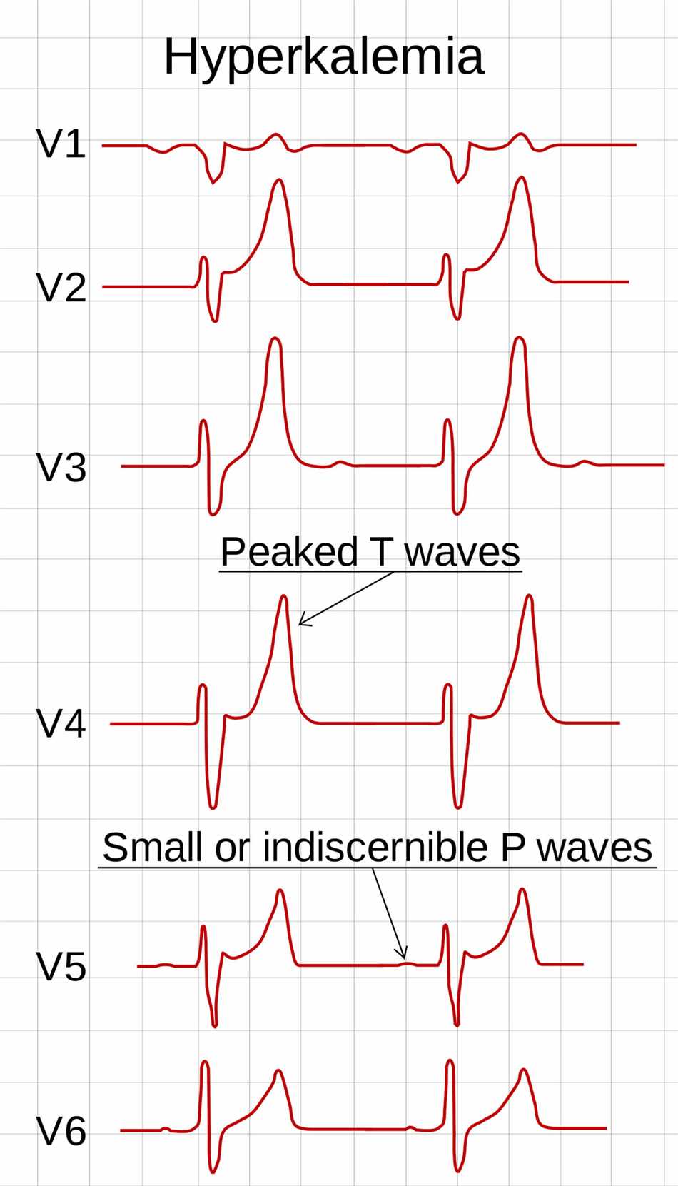 Ecg changes amitriptyline